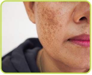 Best Melasma Removal Treatment in Jalandhar