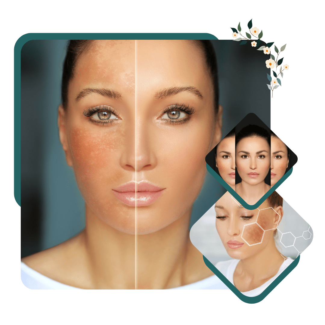 Melasma / Chloasma